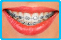 Correctores-dentales-metálicos-tradicionales